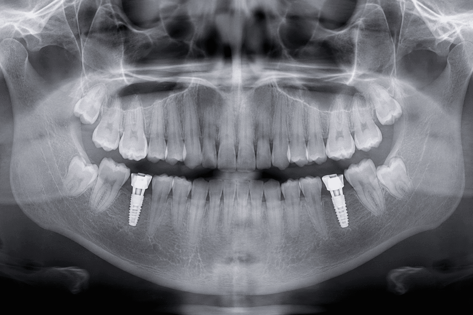 Dental Implants