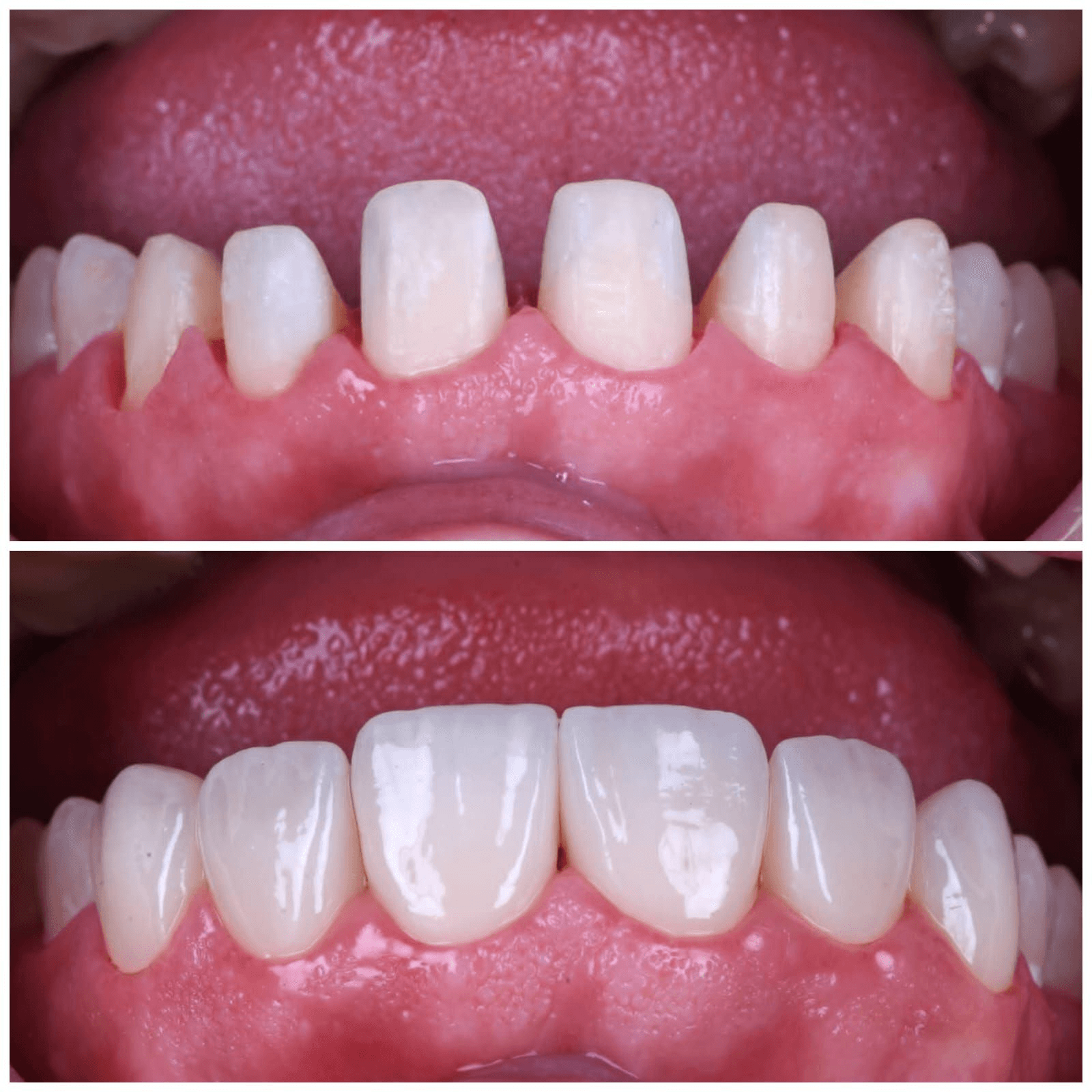 Smile Transformation