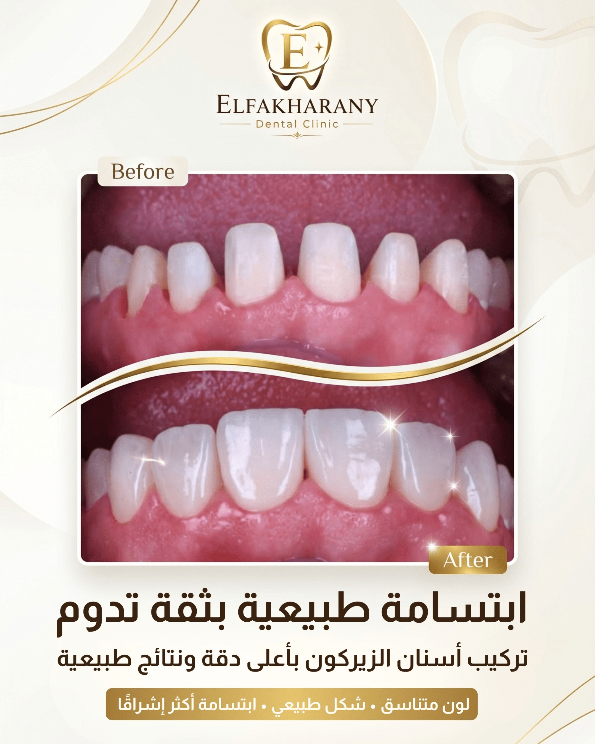 Zircon Teeth Installation